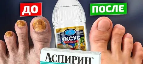 Чеснок от грибка