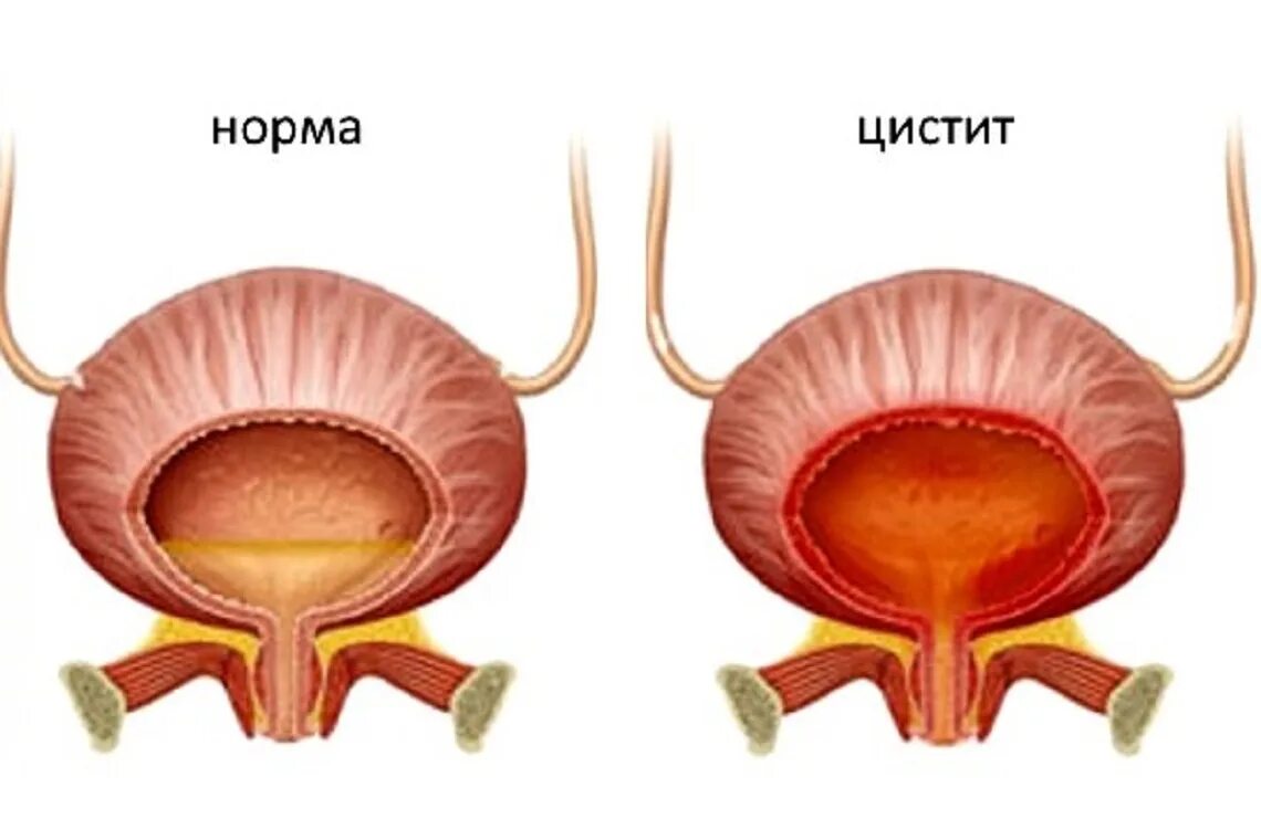 Больной мочевой