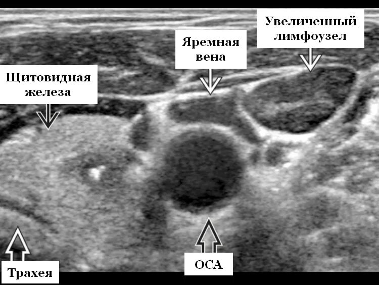 УЗИ лимфатических узлов. Ворота лимфатического узла на УЗИ. УЗИ паращитовидных желез. Реактивная гиперплазия лимфоузла