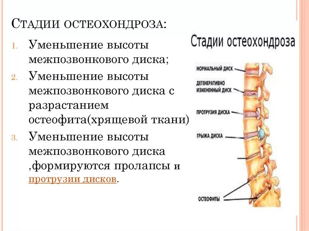 Стадии остеохондроза симптомы