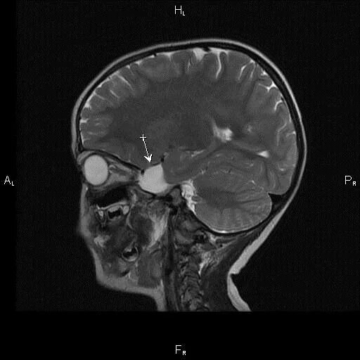 Киста головного мозга причины. Мрт головного мозга арахноидальная киста левой височной доли. Арахноидальная киста головного мозга мрт. Супраселлярная арахноидальная киста мрт. Арахноидальная киста левой височной доли мрт.