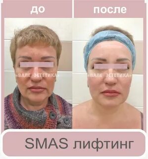 Результат сразу после