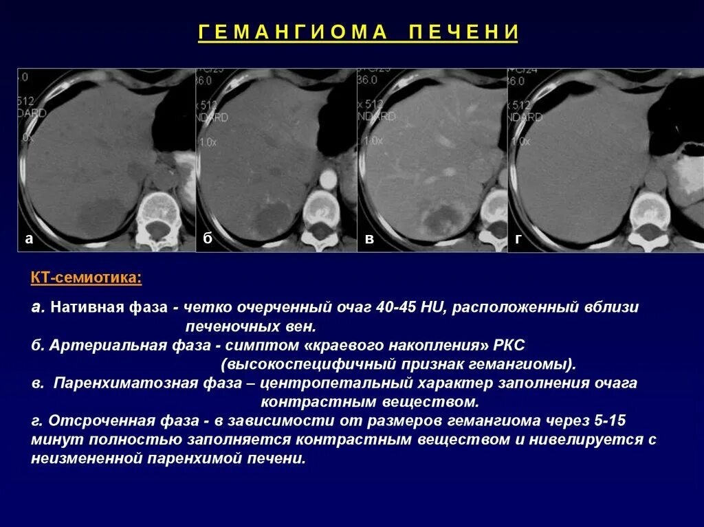 Доброкачественное образование печени. Гемангиома печени кт признаки. Атипичная гемангиома печени на кт. Множественные гемангиомы печени на кт. Гемангиома печени на кт с контрастированием.