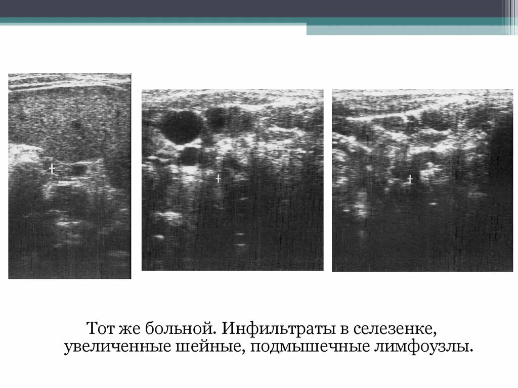 Лимфоузлы ворот печени. Лимфоузлы в воротах печени на УЗИ. Ультразвуковая диагностика заболеваний лимфатических узлов. Увеличена селезенка и лимфоузлы. Лимфоузел в воротах селезенки.