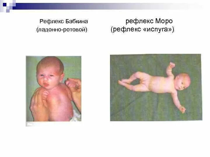 Ладонно-ротовой рефлекс Бабкина. Рефлексы Моро и Бабинского. Рефлексы Бабкина и Бабинского. Рефлексы новорожденного Бабинского Моро.