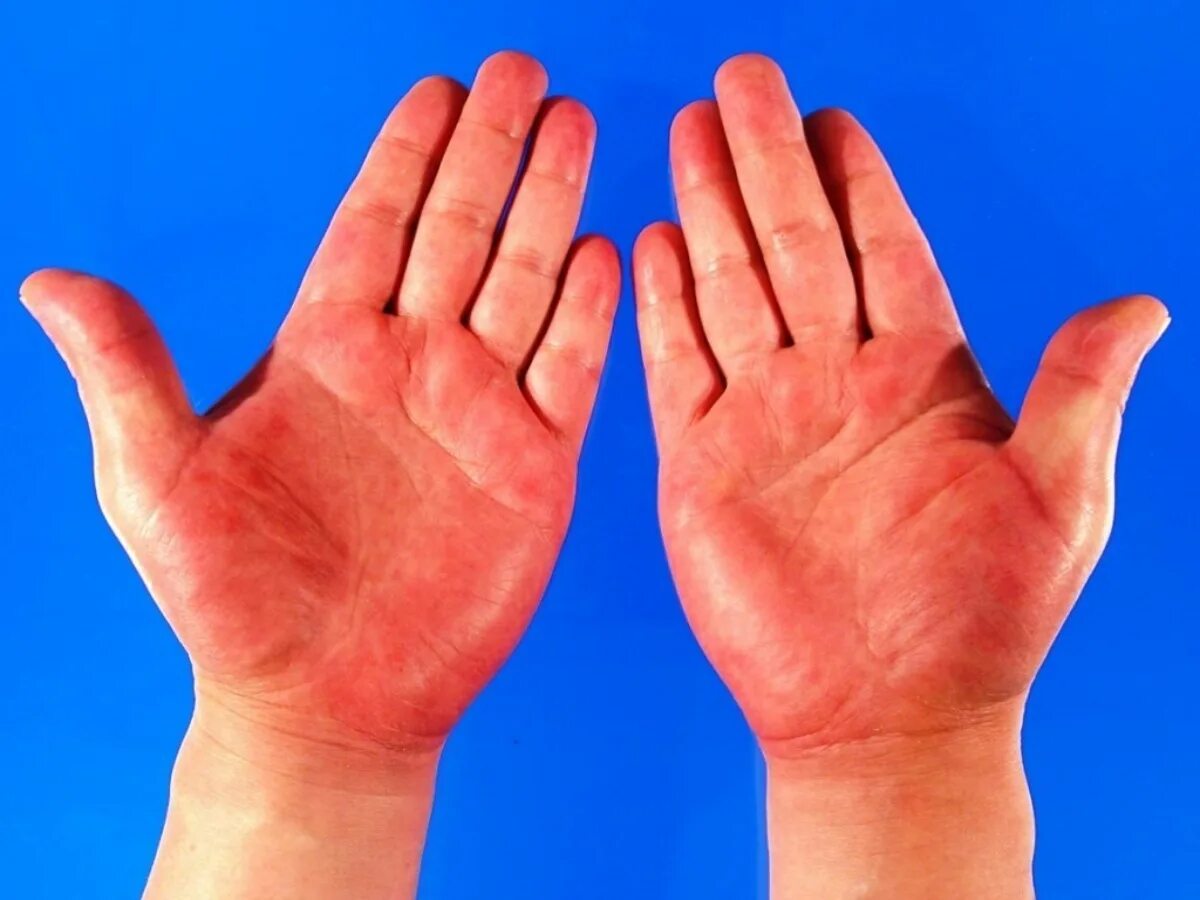 Почему руки розовые. Пальмарная эритема симптомы. Печёночные ладони (пальмарная эритема). Пальпальрная эоитрема.