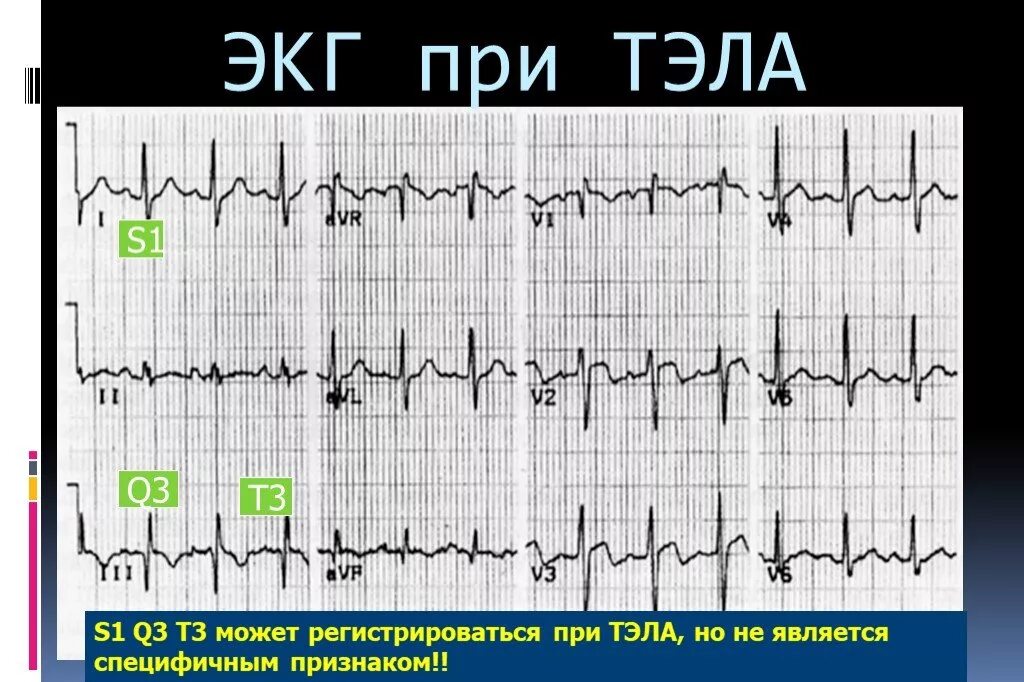 Тромбоэмболия легочной артерии экг. Тромбоэмболия легочной артерии на ЭКГ. S1q3 Тип ЭКГ. S1 q3 на ЭКГ. Тэла ЭКГ s1 q3.