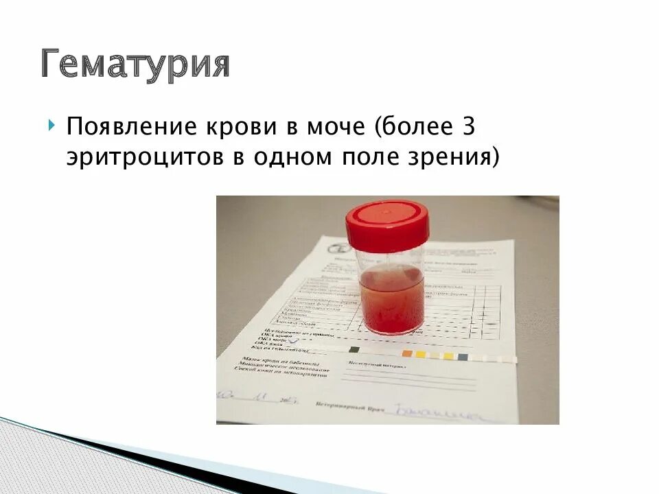 1 кровь появилась у. Гематурия в моче. Моча с примесью крови.