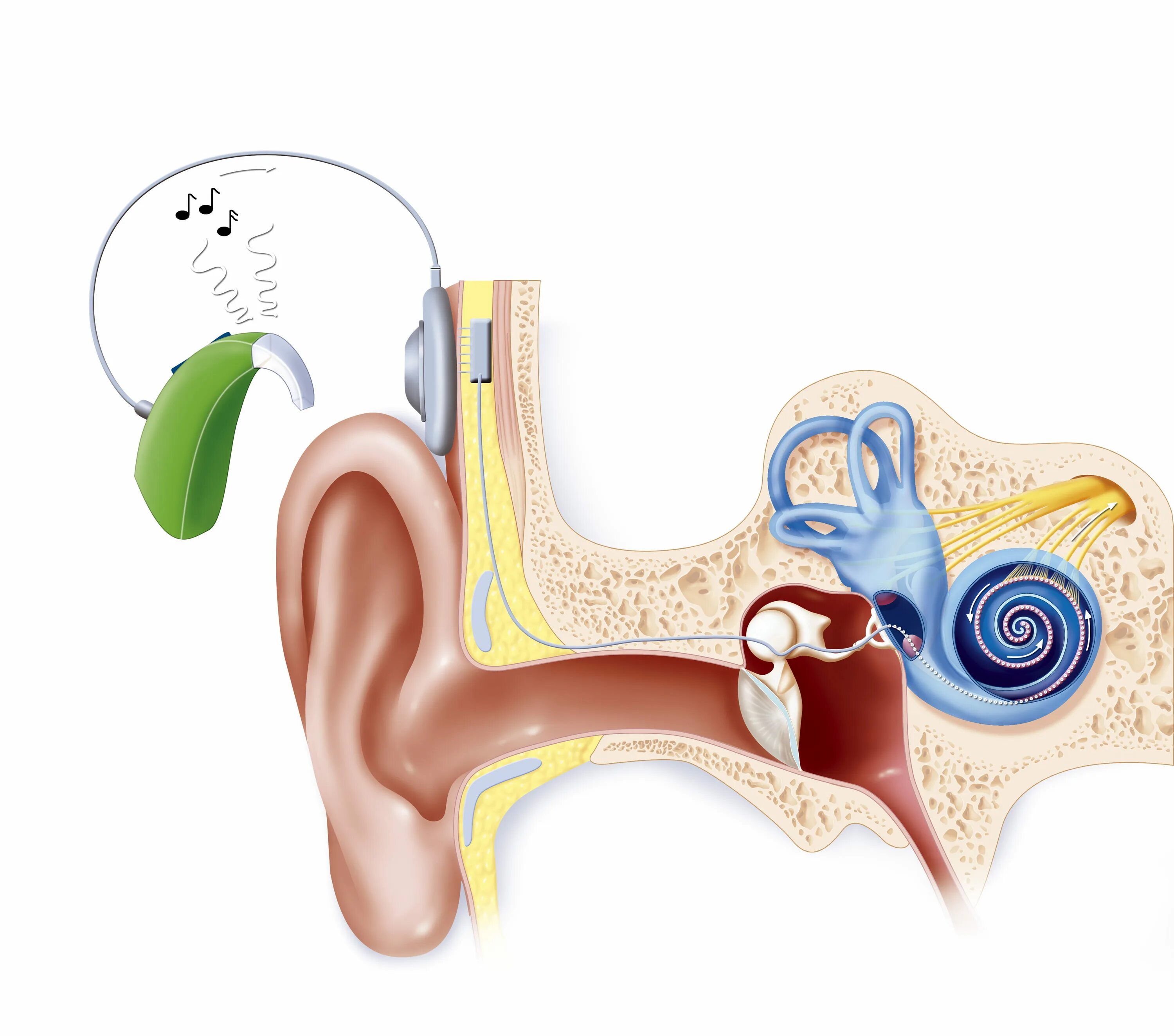 Среднее нарушение слуха. Кохлеарный имплантат нейросенсорная тугоухость. Кохлеарный имплант кохлеар. Кохлеарный неврит слухового нерва. Сенсоневральная тугоухость слуховой аппарат.
