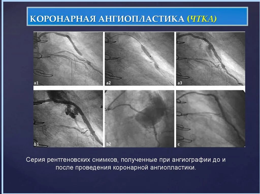 Инфаркт коронарное стентирование. ТРАНСЛЮМИНАЛЬНАЯ коронарная ангиопластика. Коронная ангионопластика. Ангиопластика при инфаркте миокарда. Коронарная ангиография при инфаркте миокарда.