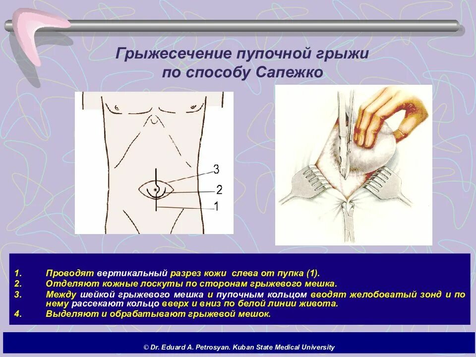 При каких размерах грыжи делают операцию