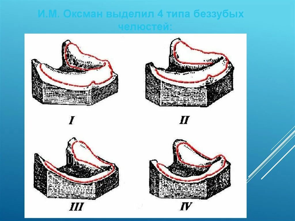 Зона податливости слизистой оболочки. Оксман классификация беззубых челюстей. Классификация слизистой по Суппле. Классификация слизистой оболочки беззубых челюстей. Классификация беззубых челюстей по Суппле.