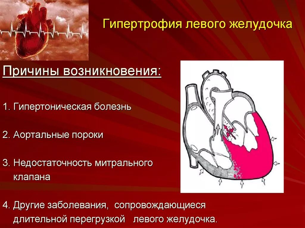 Заболевания левого желудочка. Гипертрофия миокарда левого желудочка при гипертонической болезни. Причины развития гипертрофии левого желудочка. Гипертрофия миокарда лж причина. Гипертрофированный миокард левого желудочка причины.