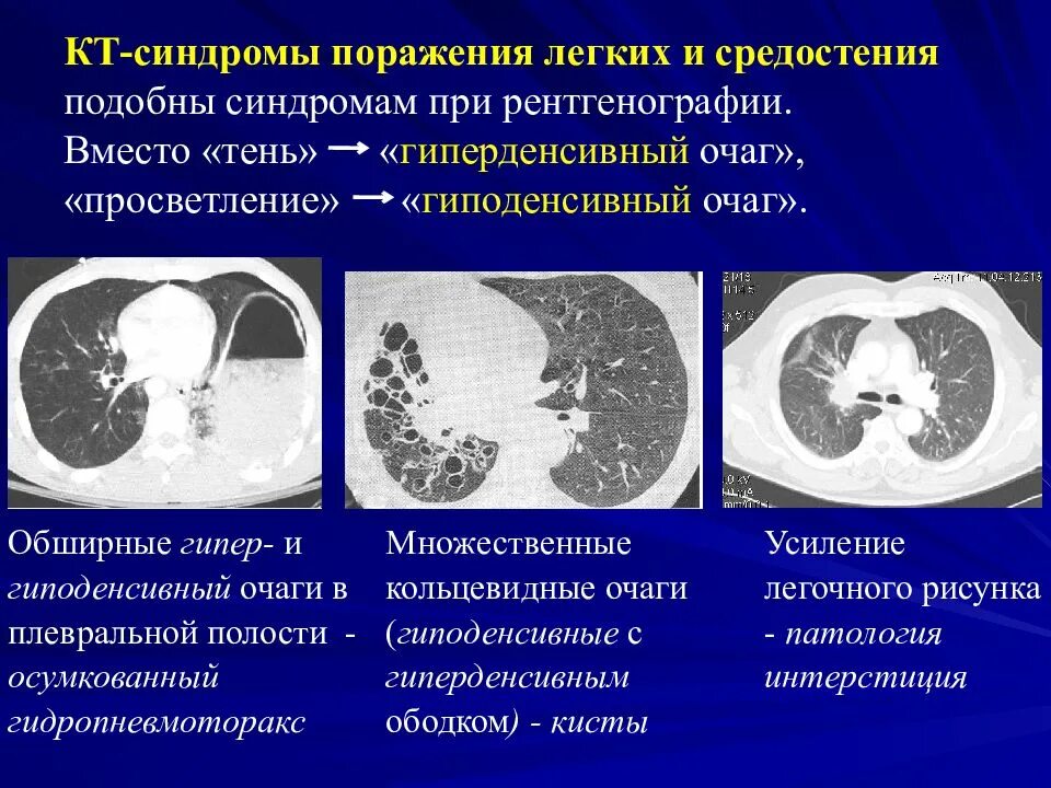 Дерева в почках в легких кт. Гиперденсивный очаг в печени кт. Гиперденсивный очаг на кт. Поражение легких на кт. Очаговое поражение легких кт.