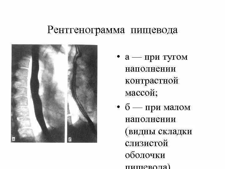 Дефект наполнения пищевода. Дефект наполнения пищевода