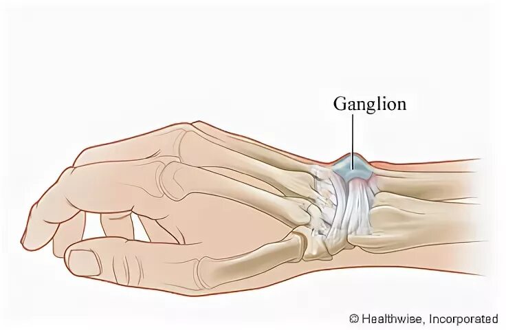 Гигрома лучезапястного сустава. Гигрома (ганглий) лучезапястного сустава. Гигрома лучезапястного сустава анатомия. Ганглий локтевого сустава.
