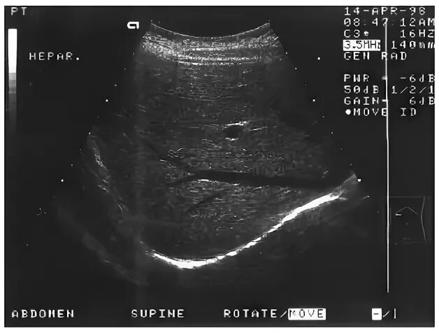 Узи сосудов печени. Рубцовая ткань печень УЗИ. Здоровая печень на УЗИ. Печень УЗИ поверхности печени.
