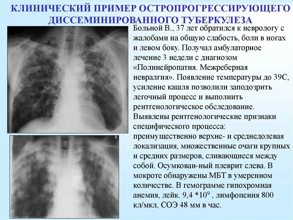 При туберкулезе чаще поражаются