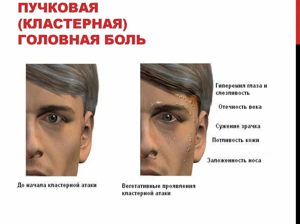 Почему болит голова и давит на глаза. Кластерная головная боль симптомы. Кла терная головная боль. Клластерная головнаяболь. Пучковая кластерная головная боль.