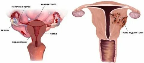 Эндометриоз после месячных