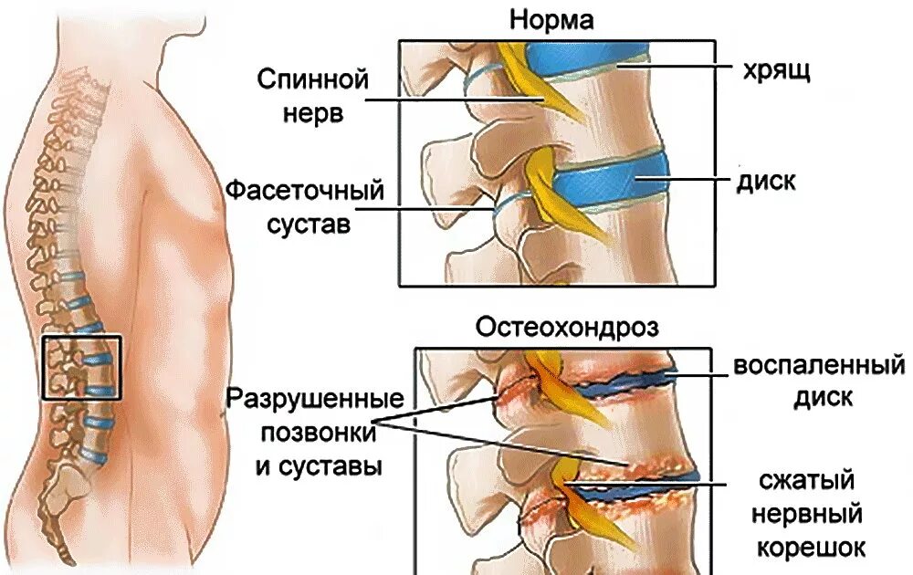 Боль в пояснице после операции