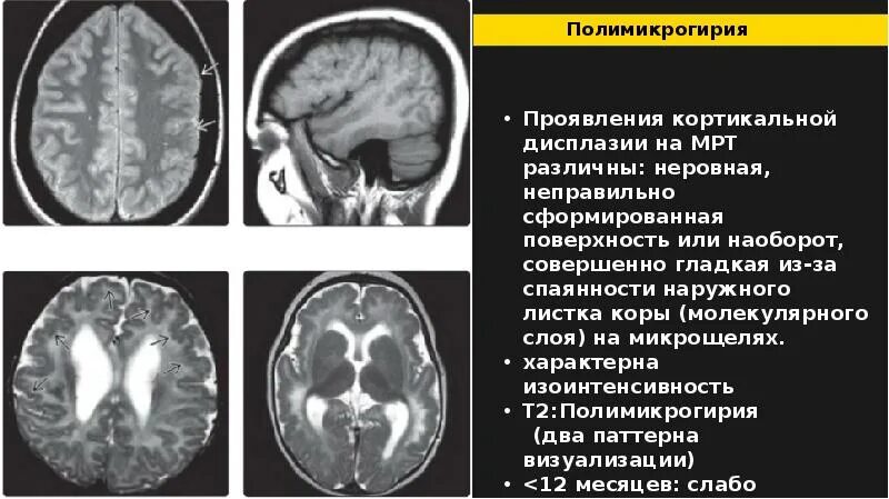 Степени атрофия мозга. Микрогирия мрт. Полимикрогирия головного мозга мрт. Пахигирия и полимикрогирия. Атрофия головного мозга на кт.