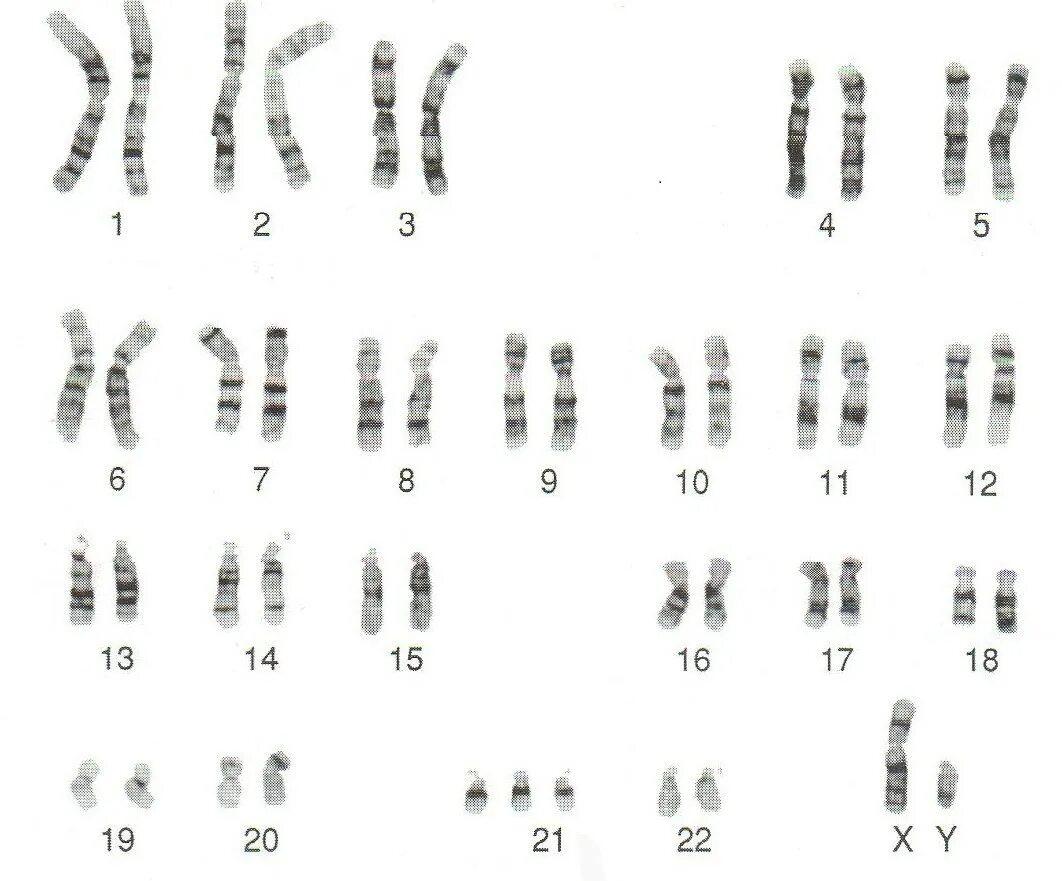 Сколько хромосом у людей с синдромом дауна. Синдром Дауна трисомия 21 хромосомы. Трисомия 21 хромосомы (синдром Дауна кариотип. Синдром Дауна трисомия 21. Синдром Дауна трисомия кариотип.