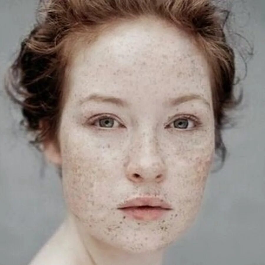 Папуло пустулезная розацеа. Жировик на лице под глазом. Розацеа телеангиэктазия. Почему щиплет кожу. Круги под глазами.