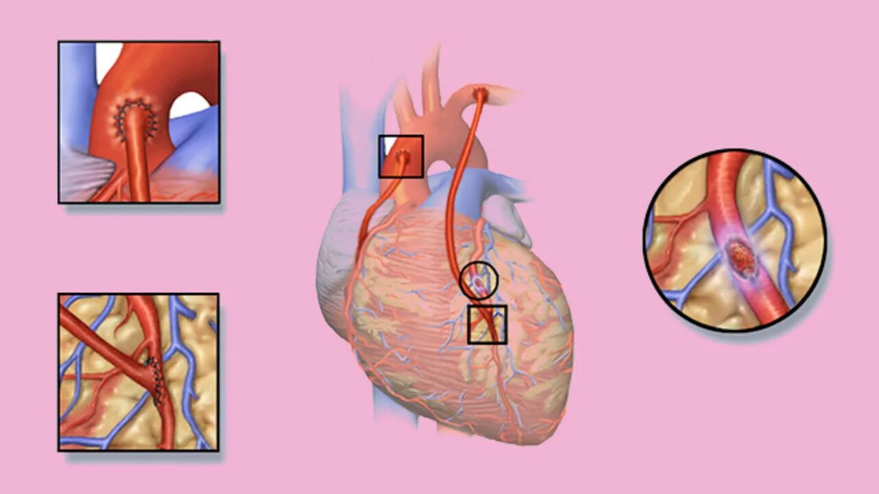 Маммарно коронарное шунтирование. Шунтирование при инфаркте миокарда. Коронарное шунтирование сосудов сердца. Аортокоронарное шунтирование при ИБС. Что такое шунтирование сердца и сосудов