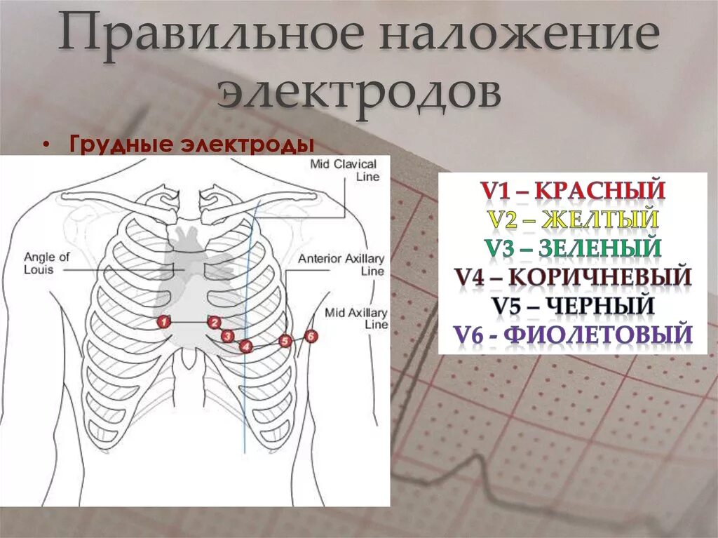 Расположение 6 грудных электродов. ЭКГ сердца схема наложения электродов. Правильная постановка электродов ЭКГ. Правильное наложение электродов при снятии ЭКГ. Соп экг