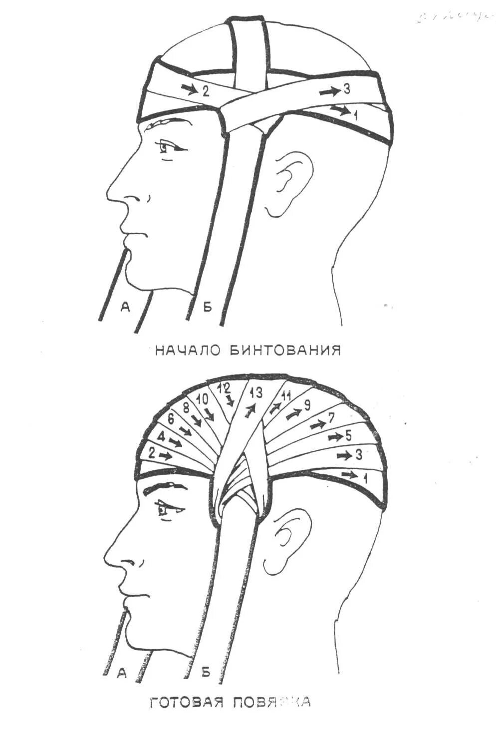 Как перевязывать голову. Перевязка головы чепец. Техника наложения повязки чепец. Техника наложения бинта на голову чепец. Перевязка головы бинтом чепец.