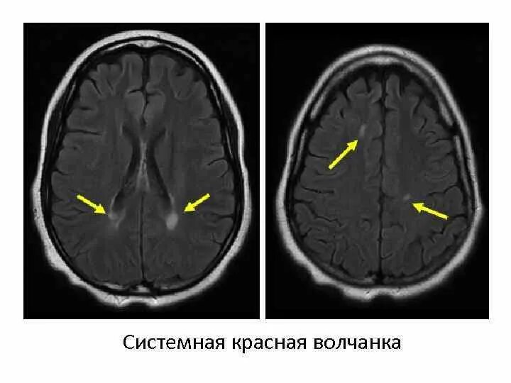 Демиелинизация головного мозга мрт. Демиелинизирующее заболевание ЦНС. Демиелинизирующий процесс головного мозга на мрт. Очаги демиелинизации головного мозга на мрт. Демиелинизация головного