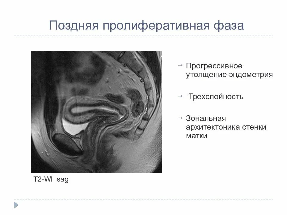 Эндометрия стенок матки. Утолщенные стенки матки. Эндометрий фаза пролиферативная. Толщина эндометрия в норме мрт.