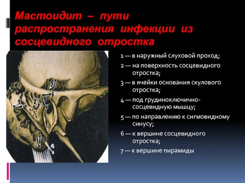 Мастоидиты воспаление сосцевидного отростка. Сосцевидный отросток кости. Мастоидит клиническая картина. Воздухоносные ячейки сосцевидного отростка. Изменения височной кости