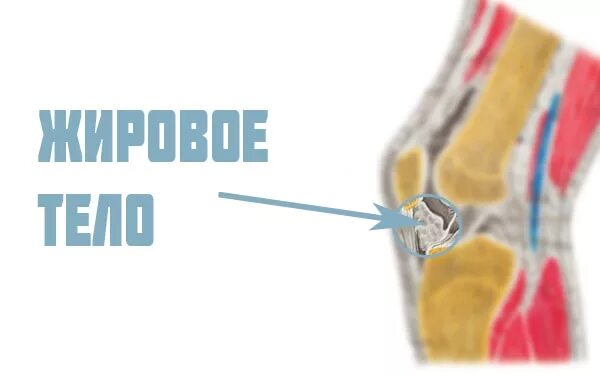 Отек гоффа коленного сустава. Клетчатка жирового тела Гоффа. Синдром жирового тела Гоффа коленного сустава. Жировое тело Гоффа коленный сустав.