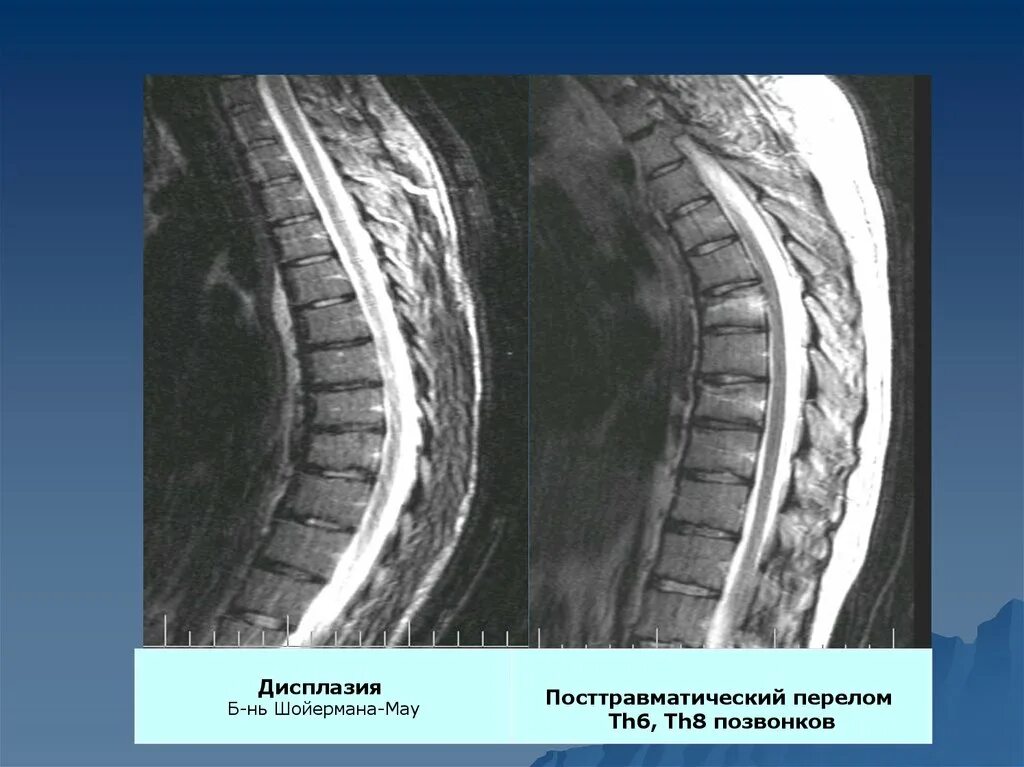 Th8 перелом позвоночника. Компрессионный перелом позвоночника th6 th7. Компрессионный перелом th6 позвонка. Компрессионный перелом ds8 позвонка.