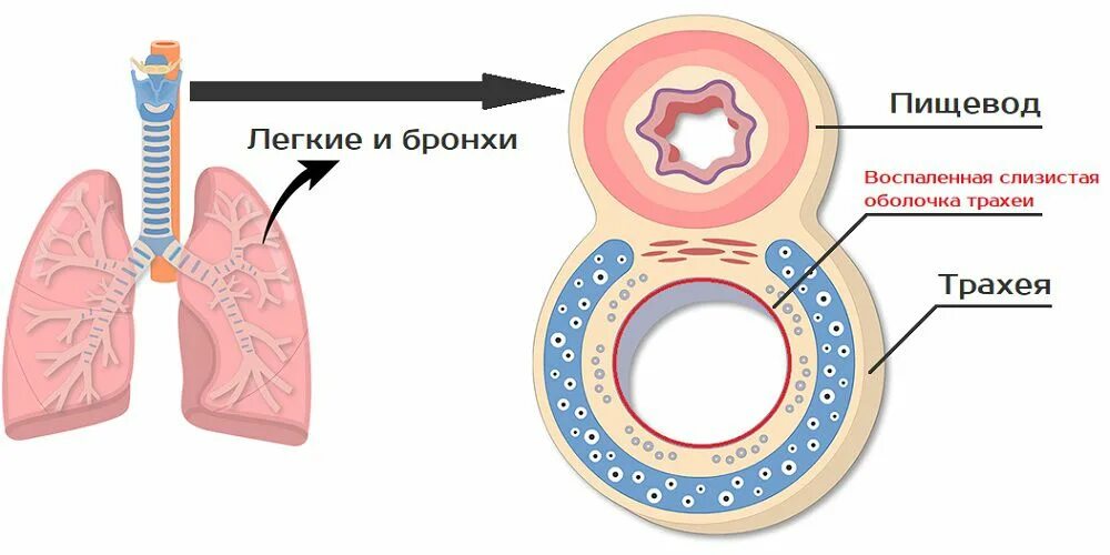 Воспаление слизистой трахеи. Осложнения трахеи