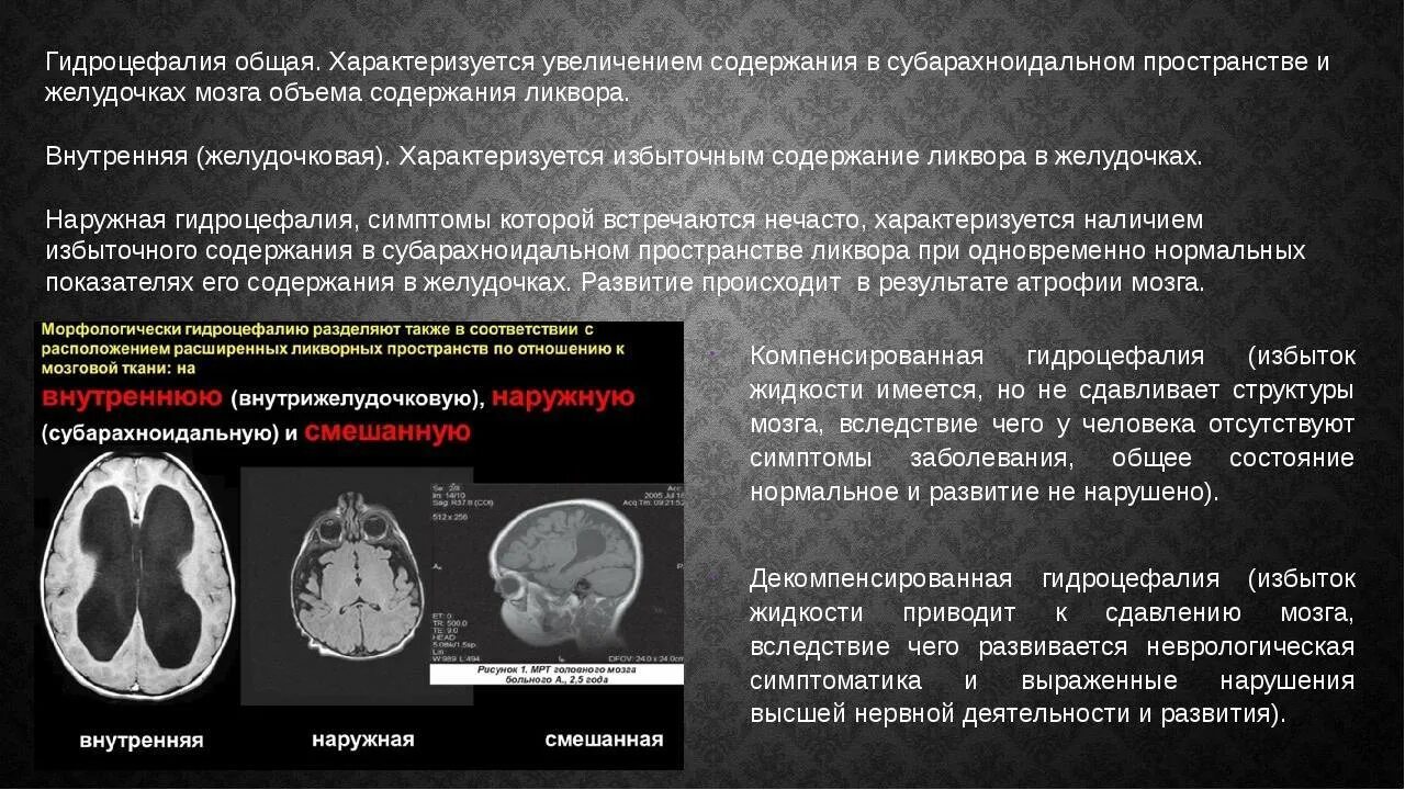 Диффузные изменения мозга у ребенка. Заместительная наружная гидроцефалия кт. наружная гидроцефалия на кт. кт признаки гидроцефалии. внутренняя гидроцефалия на кт головного мозга.