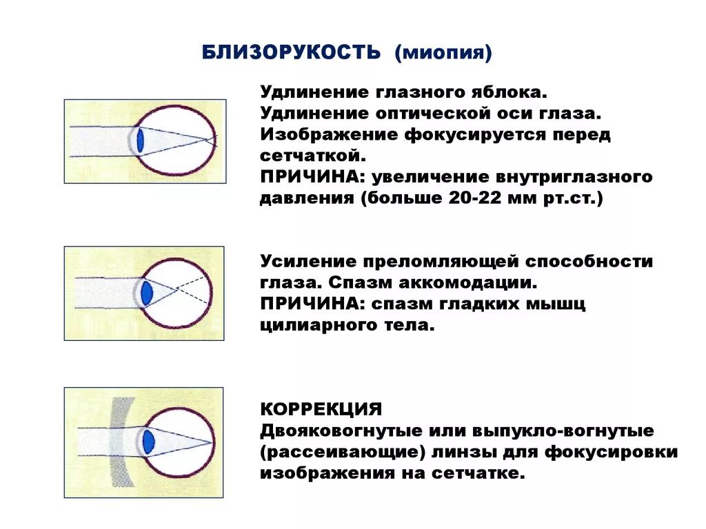 Миопия глазное яблоко. Осевая форма миопии. Какое заболевание возникает при удлинении глазного яблока. Удлинение оси глазного яблока.