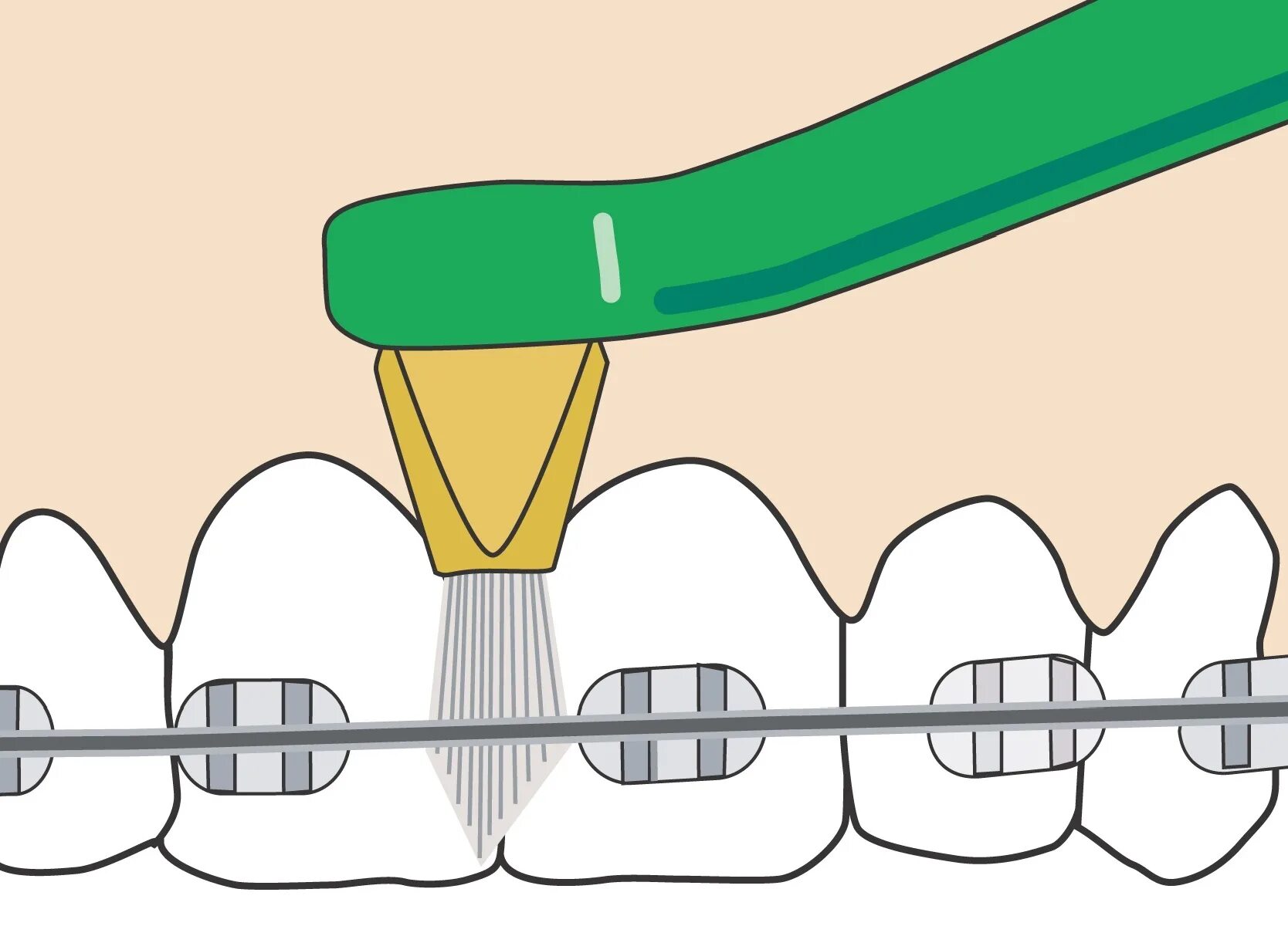 V образная щетка ортодонтическая. Ершики ортодонтические. Сена зуб