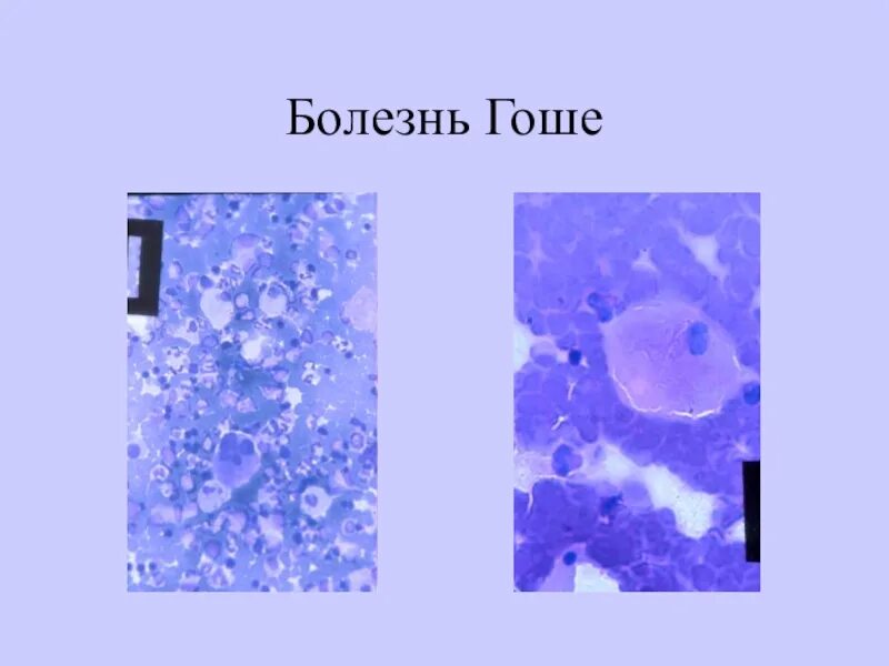 Болезнь гоше препараты. Болезнь гоше препараты. Болезни связанные с нарушением функции лизосом. Болезнь гоше презентация. Болезнь гоше препараты.