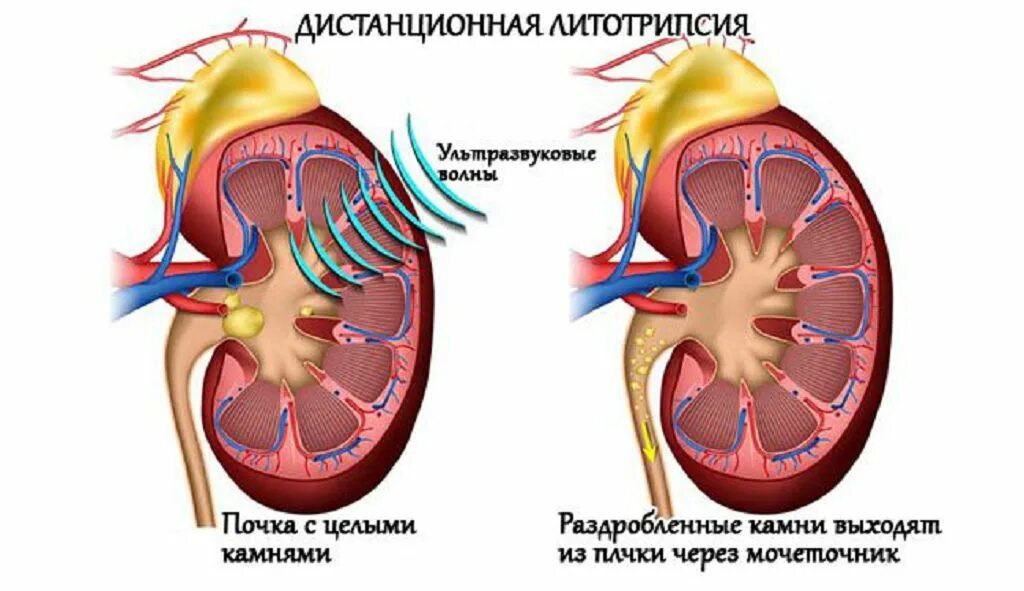 Заболевания мочевыделительной системы мочекаменная болезнь. Виды камней в мочеточнике. Как облегчить выход камня. Комплекс упражнений при мочекаменной болезни. Камни в почках застревание.
