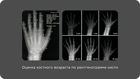 Таблица костного возраста ребенка