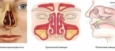 Полипозный гайморит