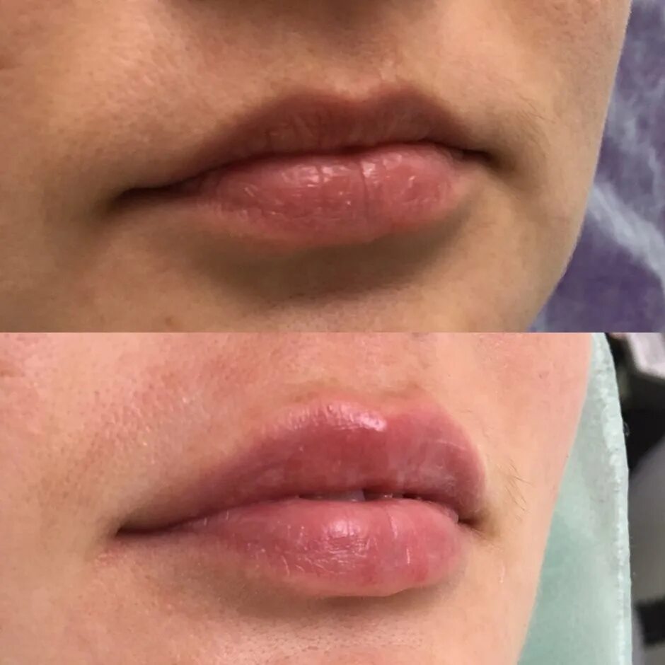 Исправление асимметрии губ филлером. Аугментация губ филлером на основе гиалуроновой кислоты. Губы после коррекции филлером. Ювидерм принцесс волюм. Бьютификация губ гиалуроновой кислотой.
