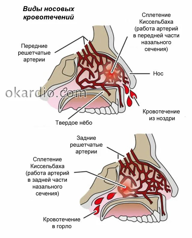 Кровотечение из носа из одной ноздри причины. Нососовое кровотечение. причины кровотечения из носа.