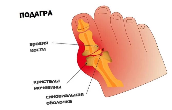 Болит основание сустава большого пальца. Сустав большого пальца ноги. Подагра большого пальца стопы. Болит сустав большого пальца на ноге.