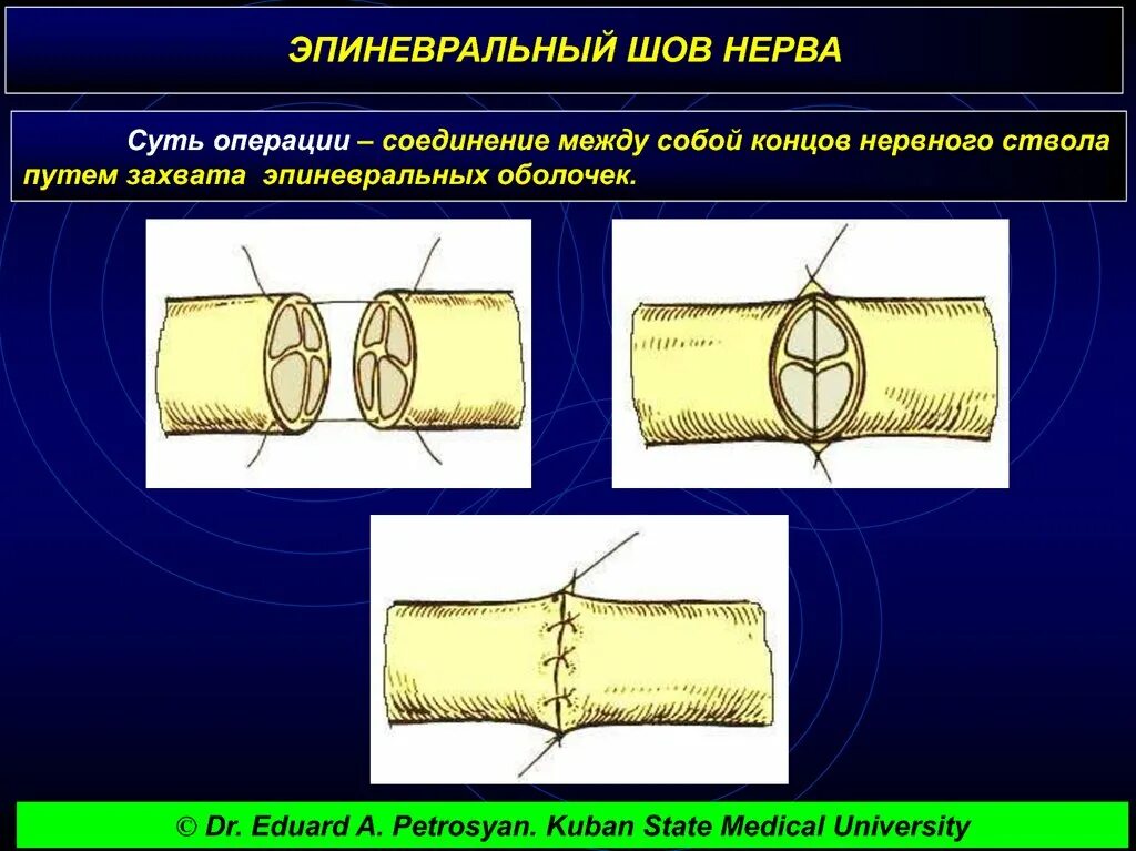 Сшивание нерва латынь. Эпиневральный шов нерва. Периневральный шов нерва техника. Операции на нервах: шов нерва, невролиз..