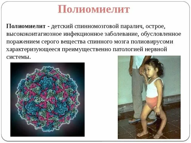 Полиомиелит это простыми словами. Специфическая профилактика полиомиелита. Клинические симптомы полиомиелита. Бульбарный полиомиелит. Неспецифическая профилактика полиомиелита.