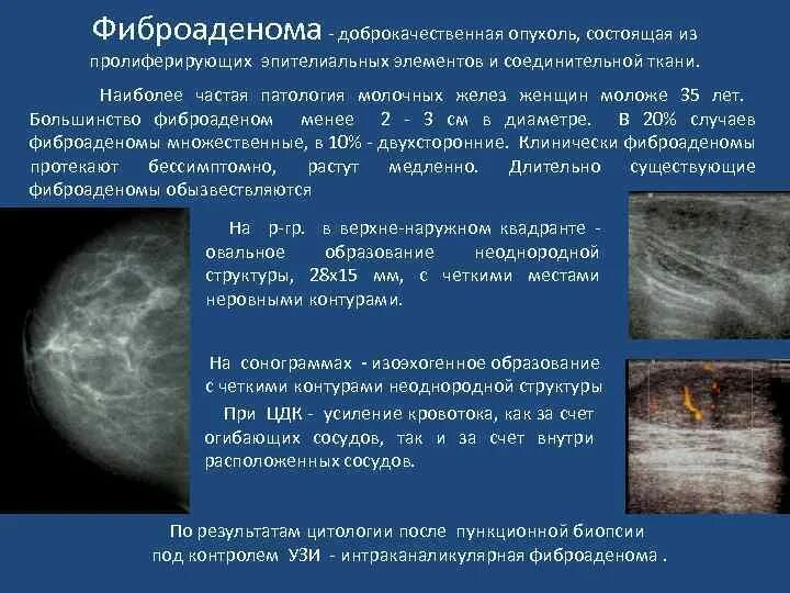 Фиброаденома молочной железы патанатомия патогенез. 2. Фиброаденома молочной железы. Локальный фиброаденоматоз молочной железы. Фиброаденома молочной железы этиология. Доброкачественные опухоли форум